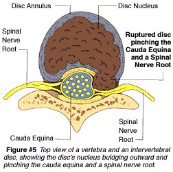 Vertebra and Intervertebral Disc