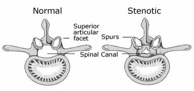 Normal Vs. Stenotic Spine Issues