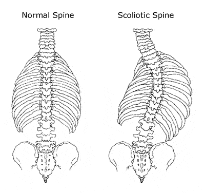 Normal Spine Vs. Scollotic Spine