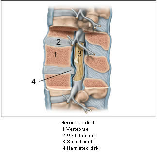 Herniated Disk